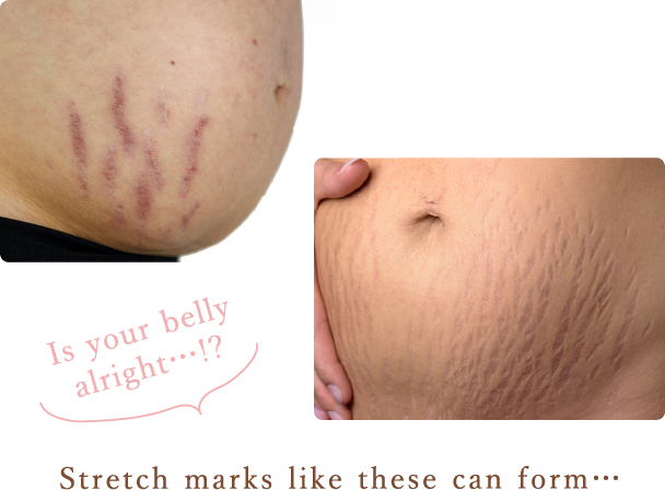 Stretch marks like these can form…